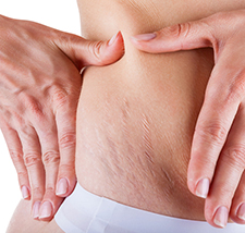 stretch marks Supplement